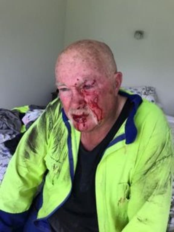 Avocado grower Robin Hanvey after he was beaten up by two men.
