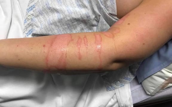 Burns on a nurse's body after she was attacked by a patient at Hillmorton Hospital in Christchurch.