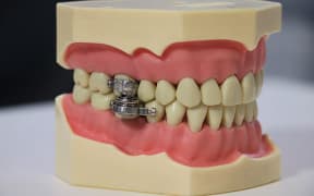 The DentalSlim Diet Control device developed by University of Otago and UK researchers allows the wearer to open their mouths only about 2mm, restricting them to a liquid diet.