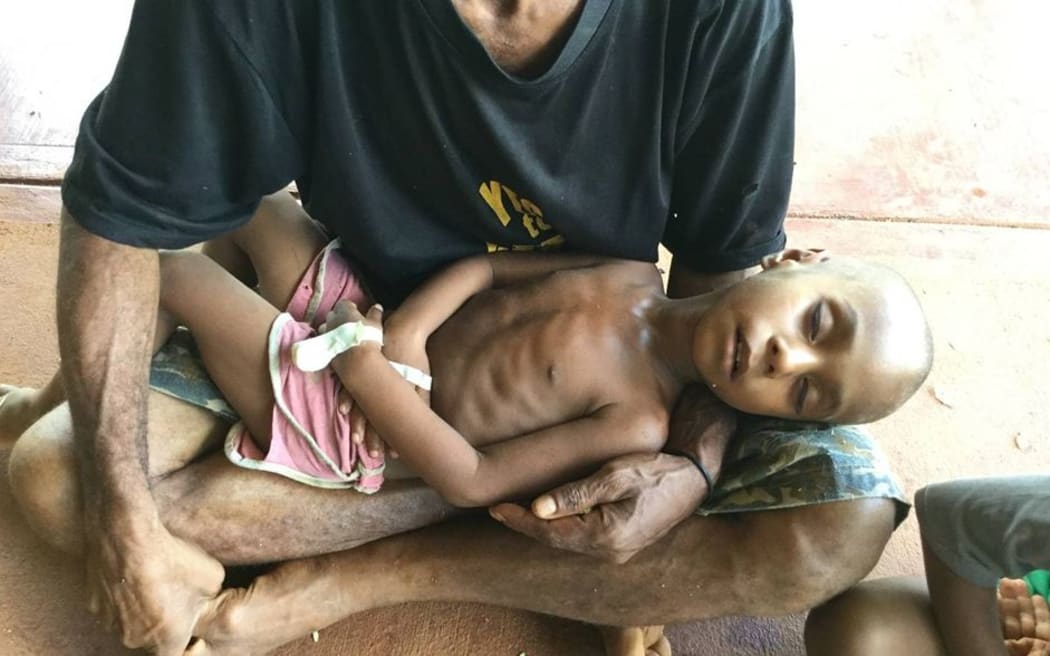 A father holds his malnourished son in Western Province, Papua New Guinea.