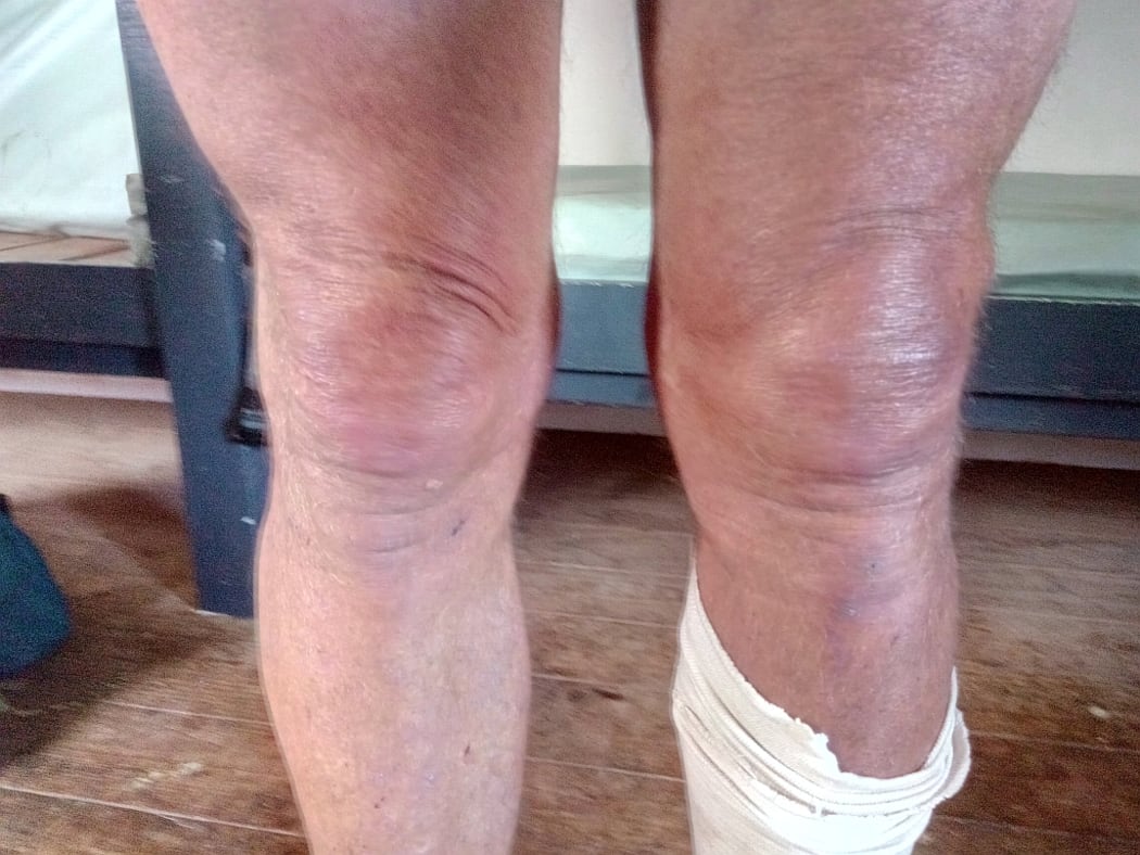 An image of Bruce's swollen left knee.