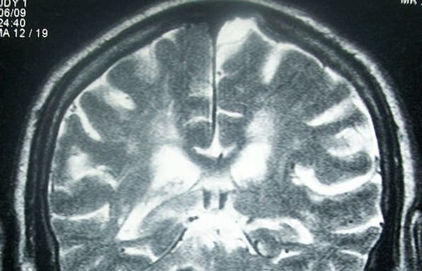 Head MRI showing deep intracerebral hemorrhage (cerebellum)