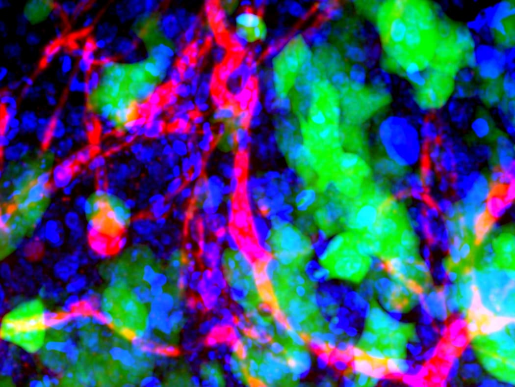 Nanoparticles in Brain Metastases