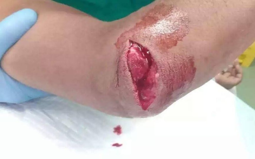 The injured arm of a Manus refugee.