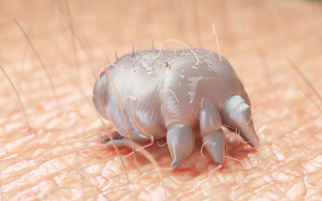 Scabies cases on rise amongst student populations but treatment access