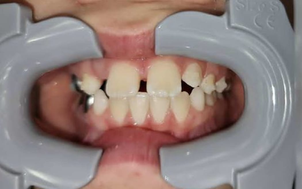 The boy's teeth when he was 10, before straightening treatment began at True Alignment Orthodontics and before all his baby teeth came out.