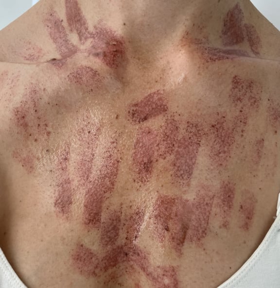 A Wellington woman has been left with burn marks all over her chest from an IPL treatment on 8 February 2024 (for use with this story ONLY).