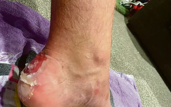 Blistered feet didn’t stop Jack Karetai-Barrett from walking for 12 hours on Tuesday.