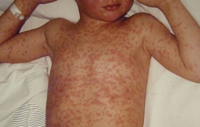 A child with measles