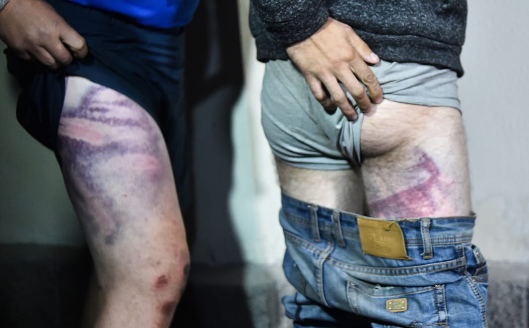 People detained during recent rallies of opposition supporters, who accuse strongman Alexander Lukashenko of falsifying the polls in the presidential election, show their traces of beatings as they leave the Okrestina prison early morning in Minsk on August 14, 2020.