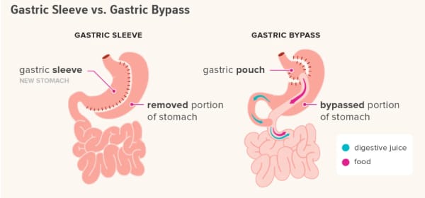 Bariatric surgery options. Image/Diego Sabogal via Healthline.com