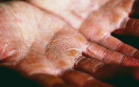 One in three New Zealanders will be at some stage affected by atopic eczema - a skin condition that causes dry, itchy, inflamed skin.