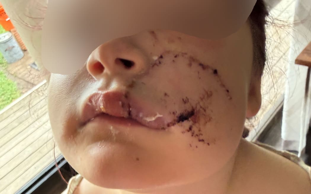 Dog attack - child victim blurred - 3 March 2026