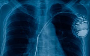 Pacemaker x-ray image.