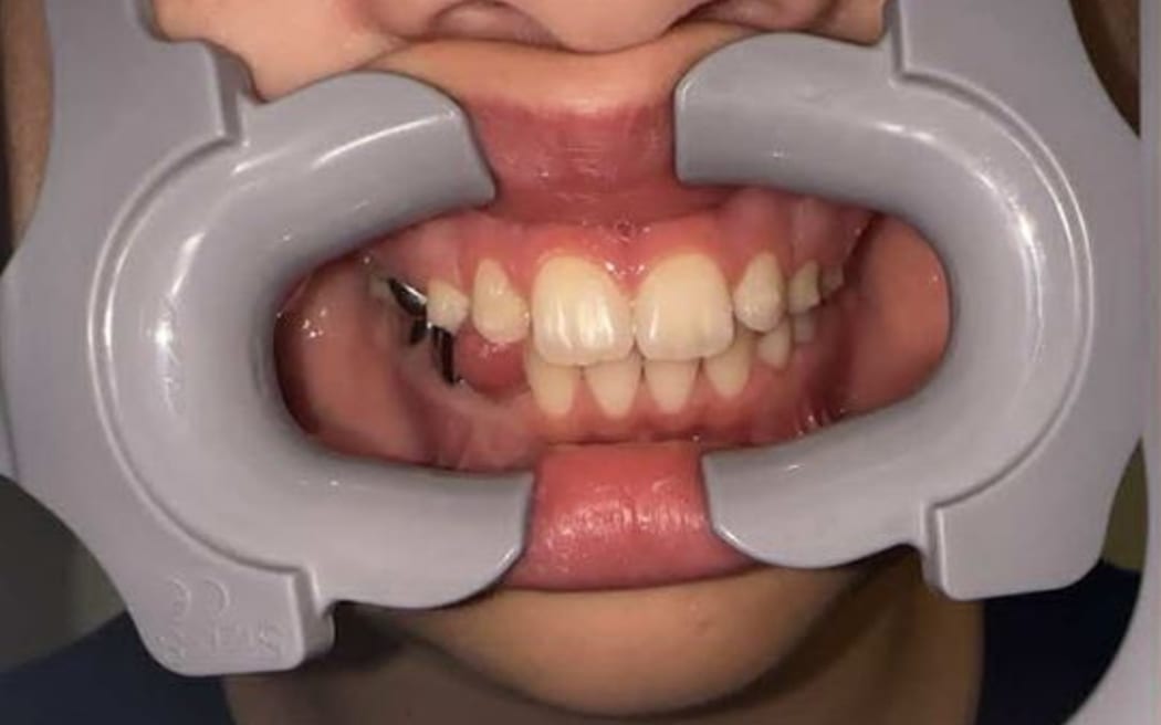 Melissa Ferguson's son's teeth about 18 months into treatment with True Alignment Orthodontics.