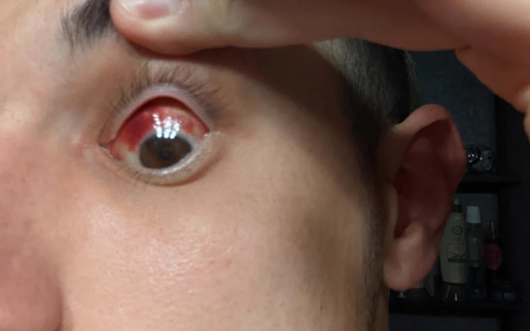 Conjunctivitis from fibre contamination was one of the symptoms for Ryan Bellotti.