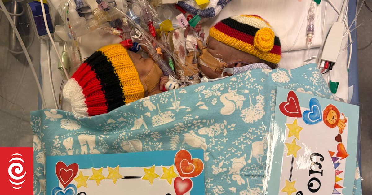 Conjoined twin dies after separation surgery