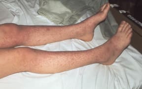 A blotchy rash is one of the symptoms of measles people should watch out for, particularly if they are not immune, the Ministry of Health said.