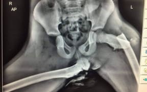 Photo tweeted by Welsh Sergeant Ian Price of horrific injuries sustained to the front seat passenger who had their feet on the dashboard.