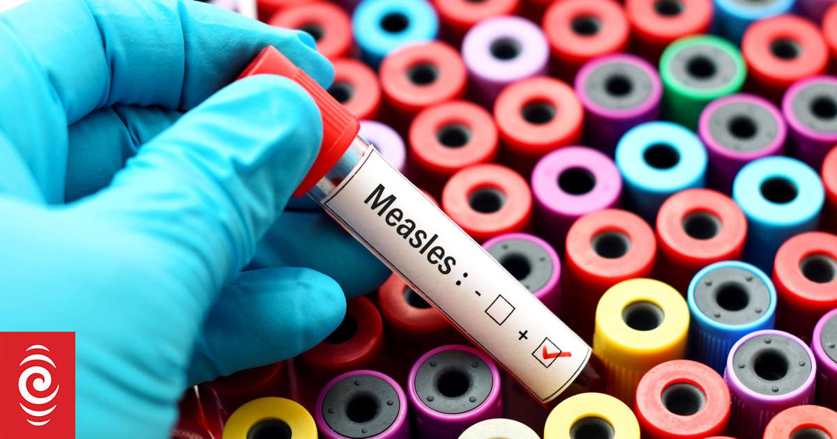 Measles 'destroys Immune System Memory', Research Finds | RNZ News