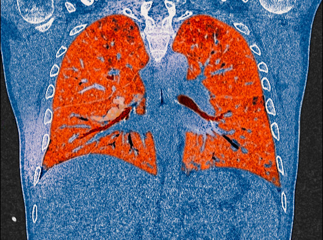 A CT scan of lungs showing the effects of Covid-19.
