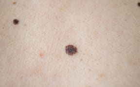 melanoma - skin cancer on a man's back