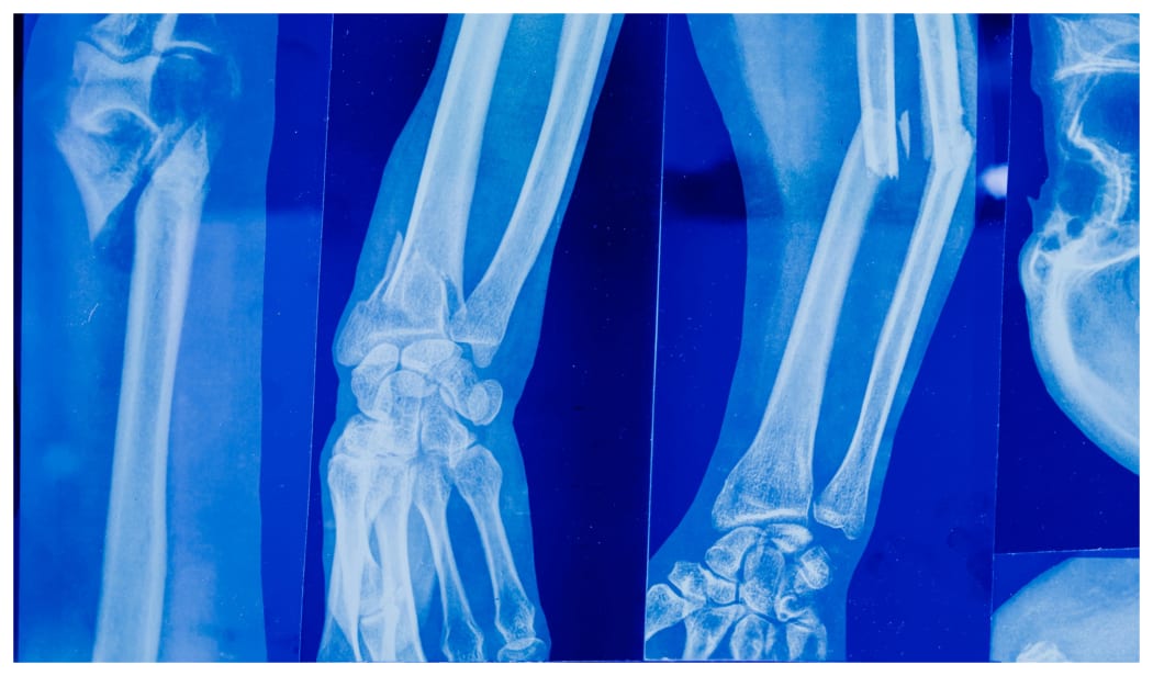 Fractured bone.