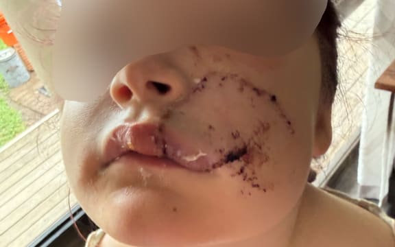 Dog attack - child victim blurred - 3 March 2026