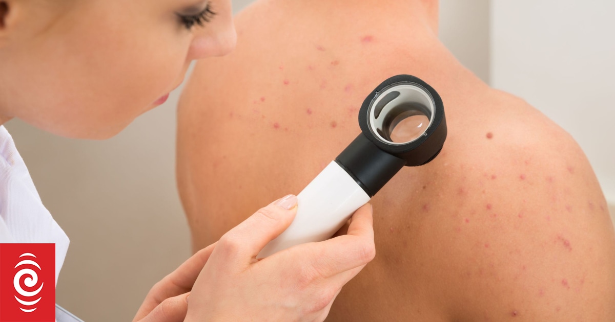 Pharmac funds nivolumab and ipilimumab for melanoma surgery patients