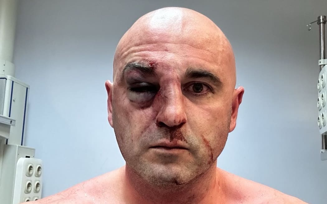 Levan Khabeishvili, chairman of Georgia's United National Movement (UNM). posted a picture of his bruised face on social media after a protest against a bill seen by some as targeting media freedoms.