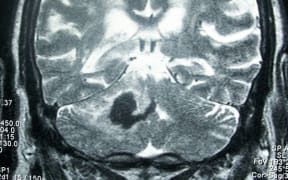 Head MRI showing deep intracerebral hemorrhage (cerebellum)