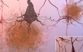 Plaques and tangles in brain tissue