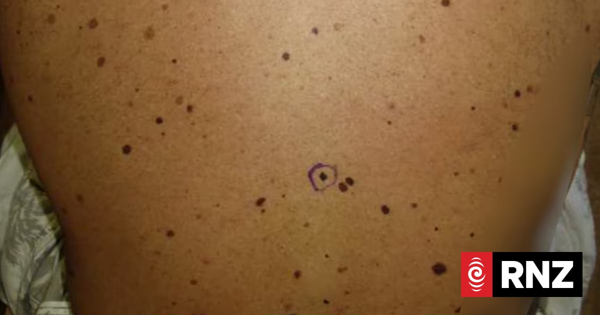 Abnormal moles seen developing in patients chasing perfect suntan by using peptide melanotan-II
