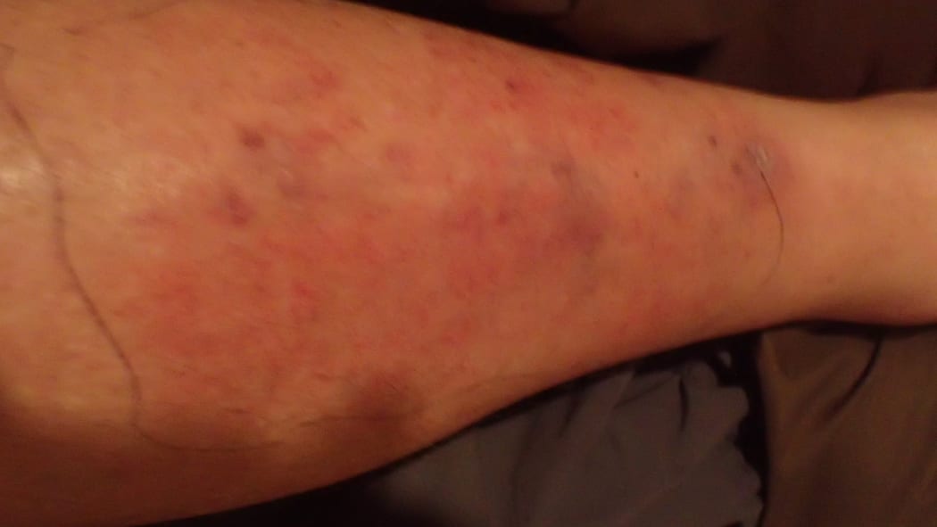 An image of Bruce's left leg, showing the extent of the cellulitis, a bacterial infection, attacking the inner layers of the skin.