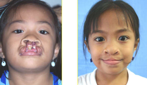 Before and after an operation through Operation Restore Hope in the Philippines.