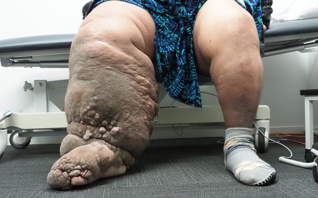 Auckland surgeon Simon Chong has carried out a pro bono surgery for American Samoan man Lautaimi Faumuina, to treat the lymphoedema that enlarged his leg.