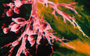 An x-ray is used to assess whether bronchiectasis is present in the lungs.