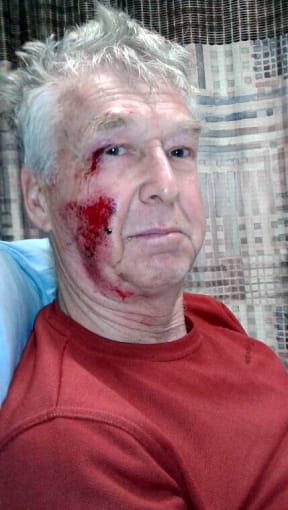 Cyclist Chris Kitson after he was knocked off his bike.
