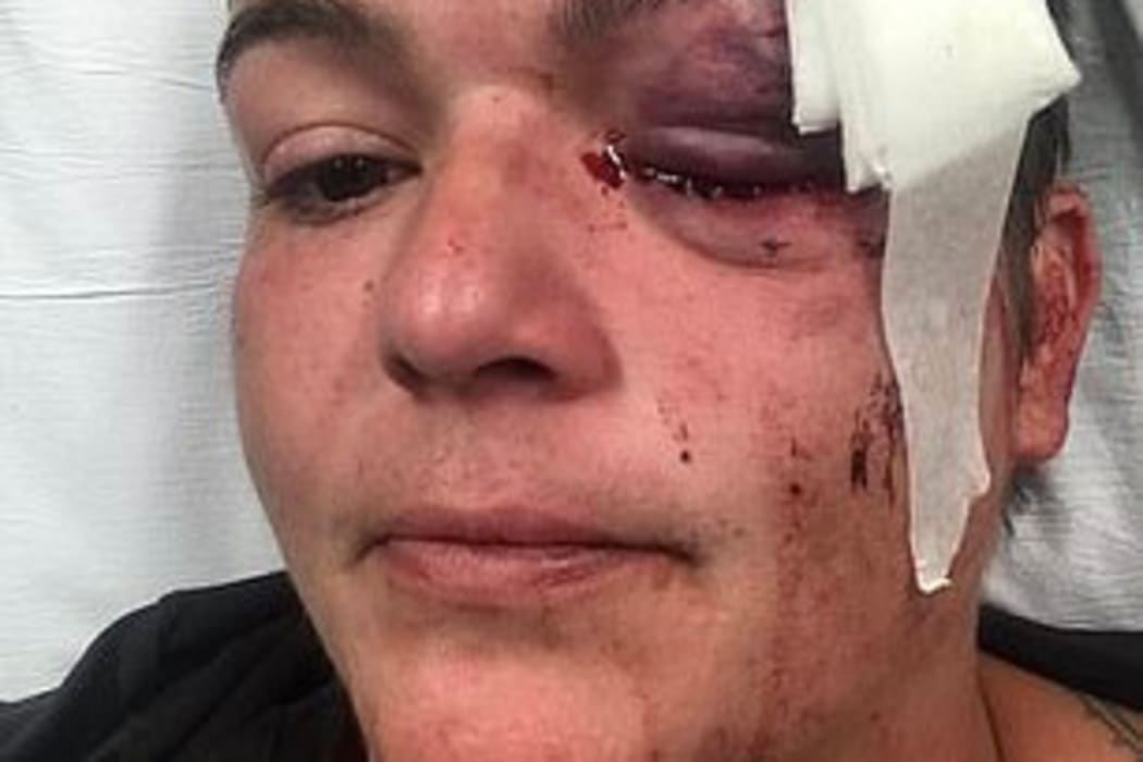 Linda Turado in hospital after a rubber bullet hit her in the eye