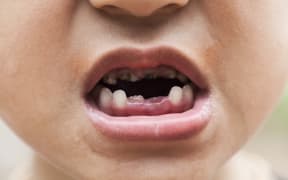 A child's mouth showing rotten and decaying teeth.
