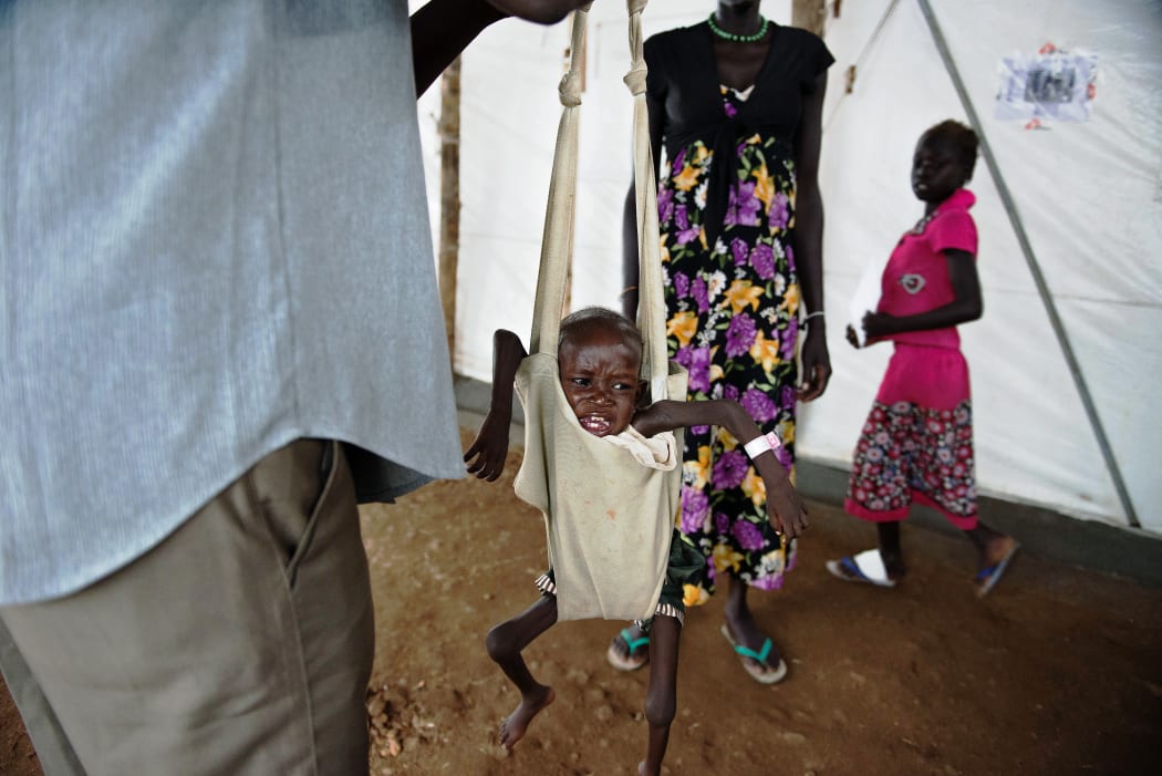 A boy suffering severe malnutrition is weighed in Juba.