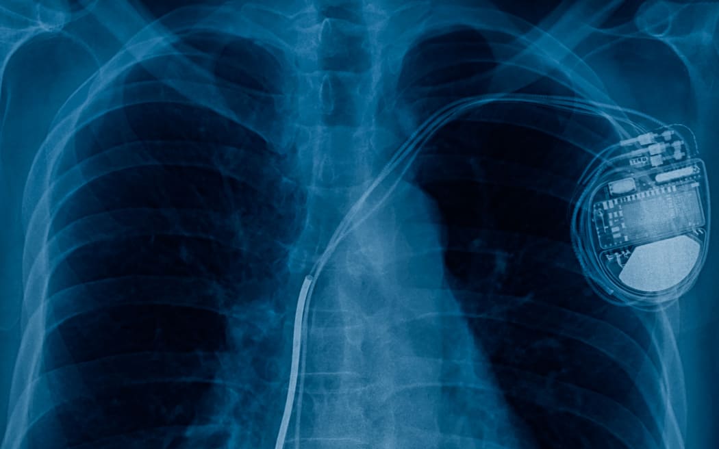 Pacemaker x-ray image.