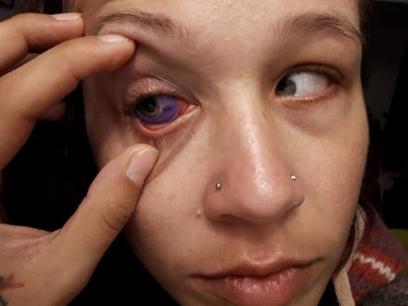 Catt Gallinger posted images on social media to warn of the dangers of eyeball or scleral tattooing.