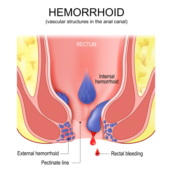 piles. hemorrhoidal disease. anatomy of internal and external hemorrhoids. Cross section of the rectum and anal canal with Pectinate line. examine rectum pain and Rectal bleeding. Vector poster