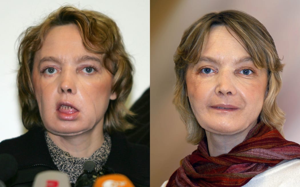 Face transplant recepient Isabelle Dinoire