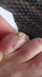 The gravel roads take their toll on Bruce's feet as closeup shot shows a toenail about to fall off his left little toe.