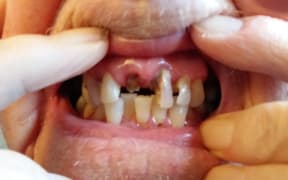 Resthome resident missing front teeth unnoticed by staff