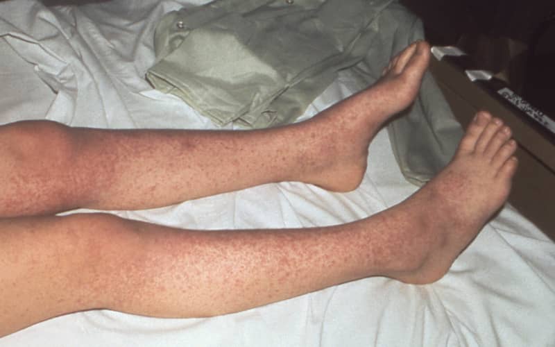 New measles case in Wellington | RNZ