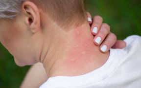 Girl with blond hair, sitting with his back turned and scratching bitten, red, swollen neck skin from mosquito bites in the summer in the forest.  Close-up up of visible insect bites. Irritated skin.
