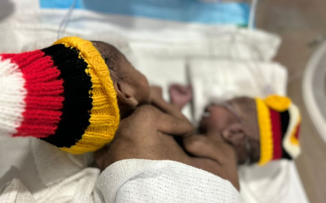 Papua New Guinea conjoined twins